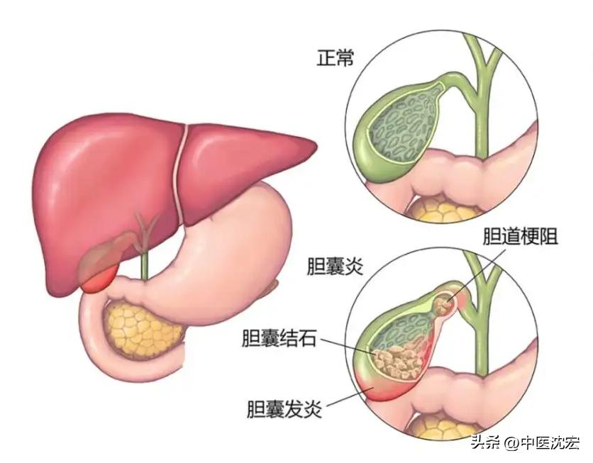 龙胆泻肝丸用法用量详解，每日服用次数指南