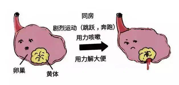 夫妻玩闹引发妻子黄体破裂